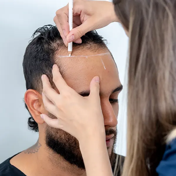 img-implante-capilar-en-medellin-1